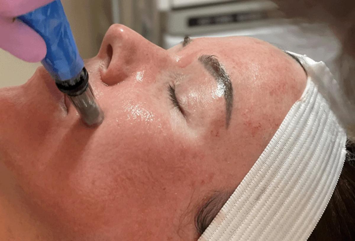 Điều trị bằng phương pháp Lăn kim (Microneedle)