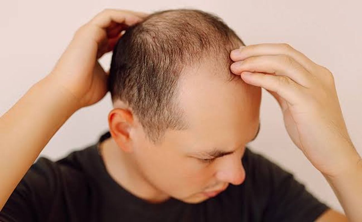 Rụng tóc nội tiết ở nam giới 