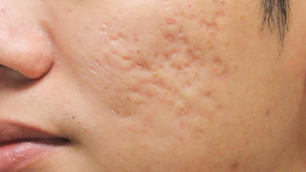 Sẹo đáy hộp ở vùng má sau khi điều trị mụn 