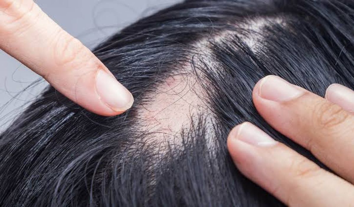 rụng tóc tự miễn gây các mảng trắng tròn 
