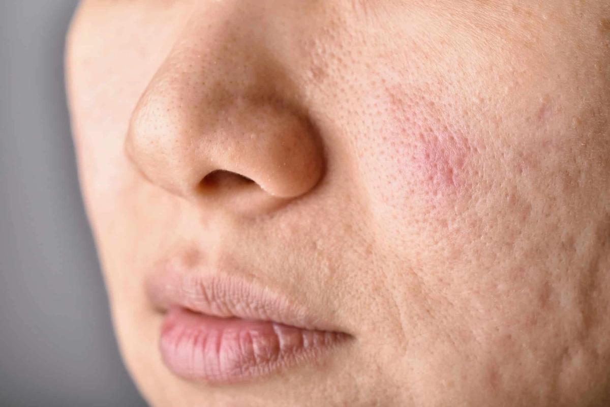 Sẹo lăn gây mất thẩm mỹ