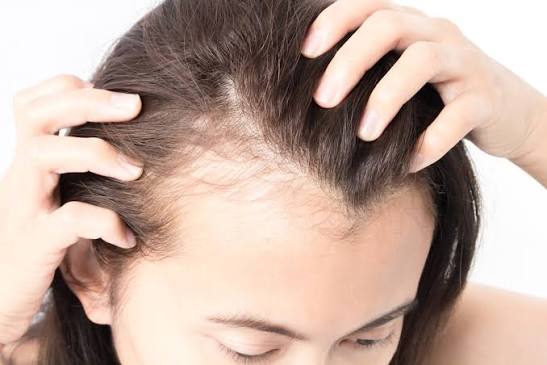 Rụng tóc do thiếu sắt