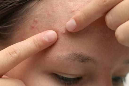 Mụn đầu trắng ở vùng trán