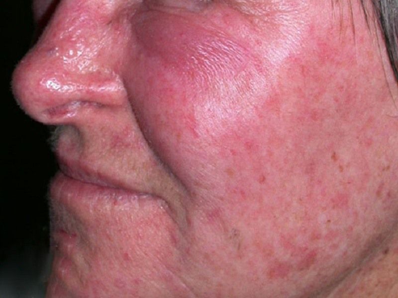 Viêm da tiếp xúc do dùng mỹ phẩm trôi nổi