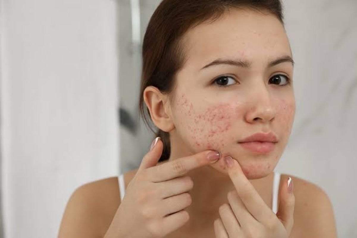 Mụn trứng cá xuất hiện nhiều ở phần má