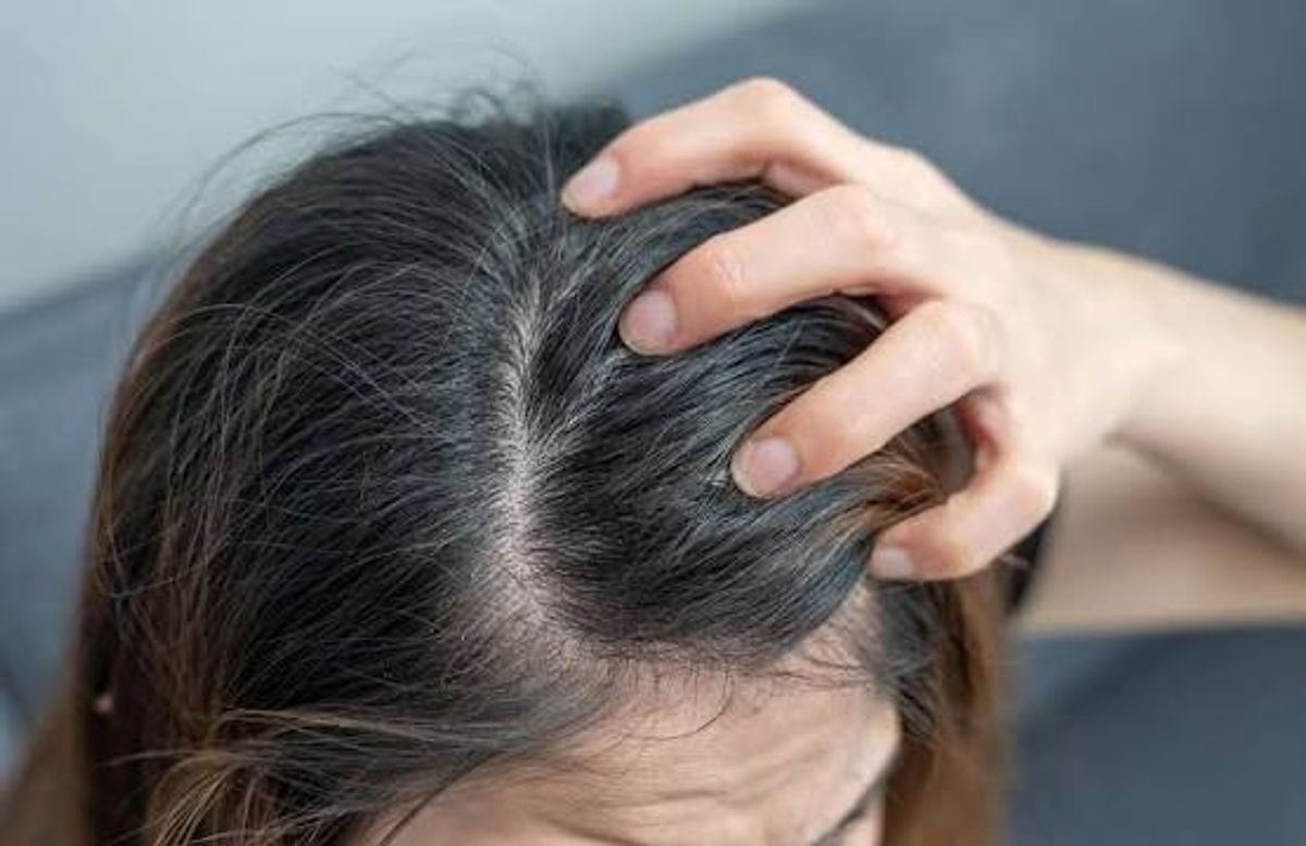 Nấm da đầu gây ngứa