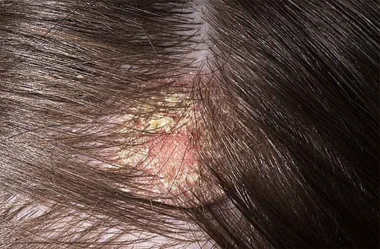 Hình ảnh nấm da đầu gây thoái hóa nang tóc và rụng tóc trên bệnh nhân bị nấm.