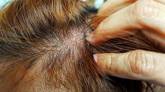 Các mảng đỏ xuất hiện do nấm da đầu