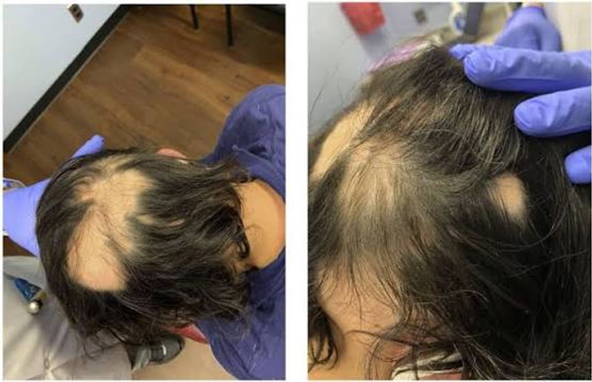 Rụng tóc ở phụ theo từng mảng lớn 