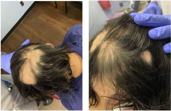 Rụng tóc ở phụ theo từng mảng lớn