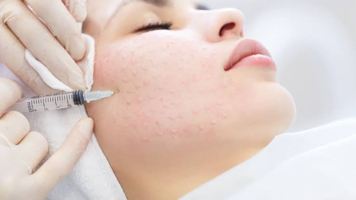 Tiêm meso điều trị mụn không viêm 