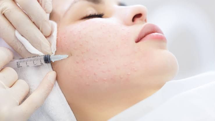 Tiêm meso điều trị mụn không viêm