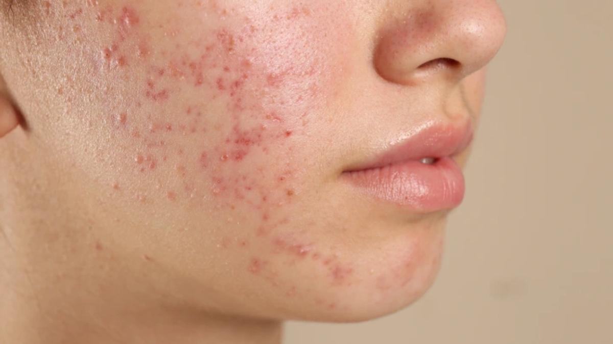 Nên tiêm meso khi đang điều trị mụn không? 