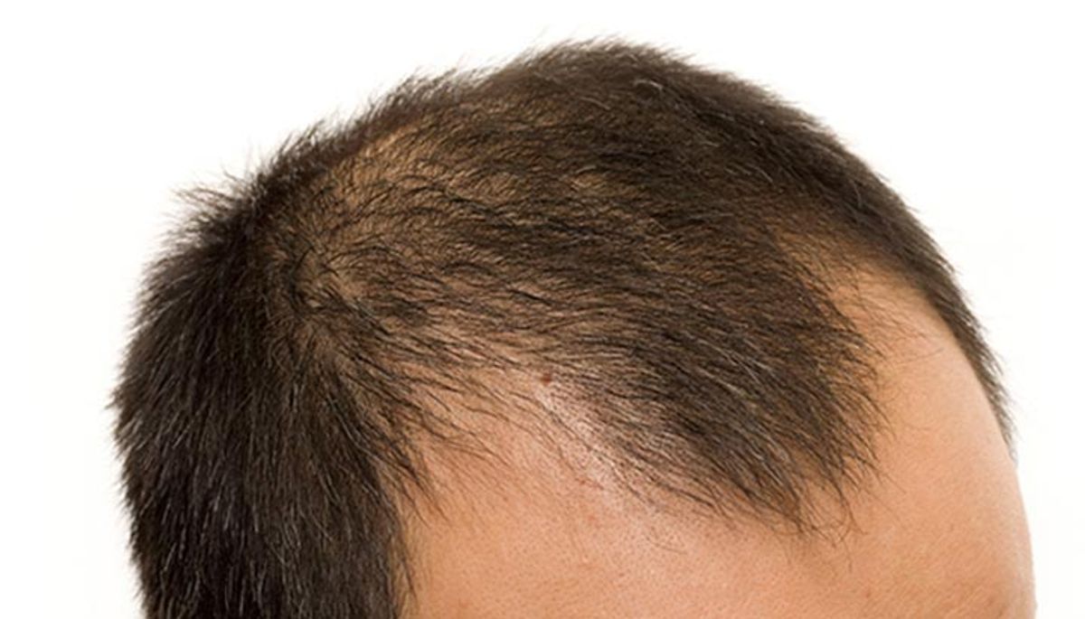 Rụng tóc androgen ở nam giới độ tuổi 30  
