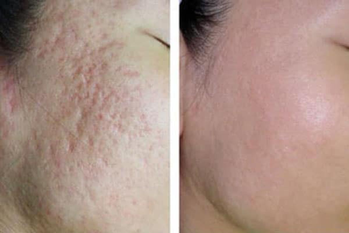 Sau tháng 2 điều trị bằng Laser CO2 Fractional