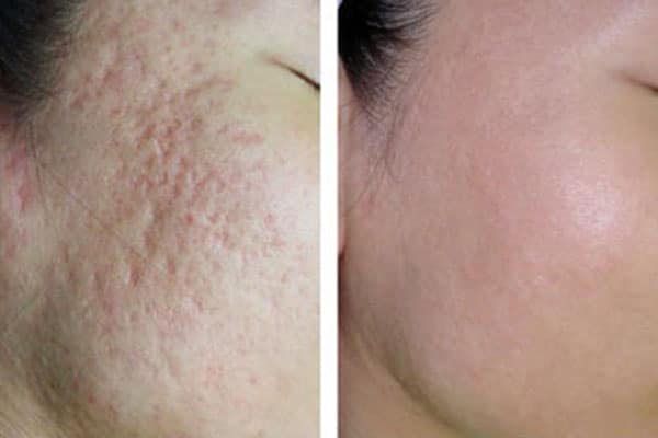 Sau tháng 2 điều trị bằng Laser CO2 Fractional