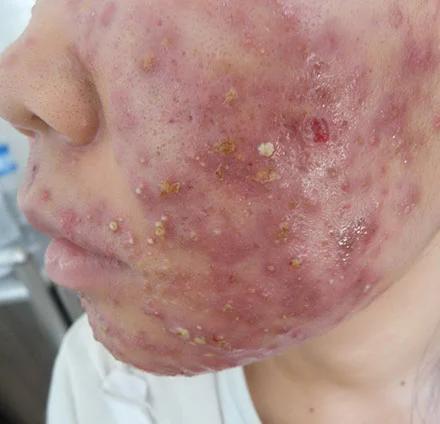 Tác hại của kem trị nám cấp tốc