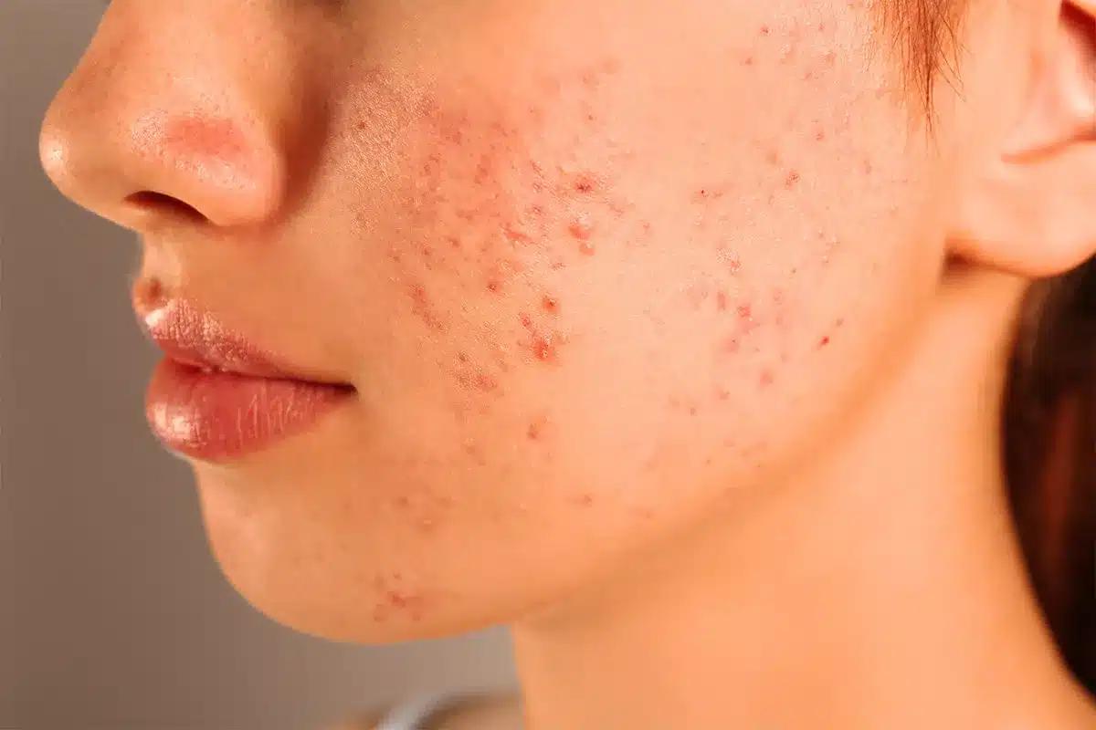 Mụn nội tiết ở vùng má