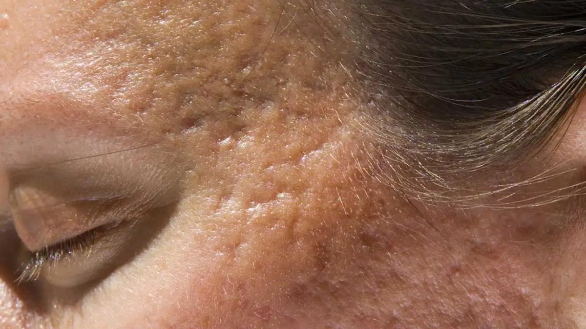 Sẹo mụn hình thành do chữa trị sai cách 