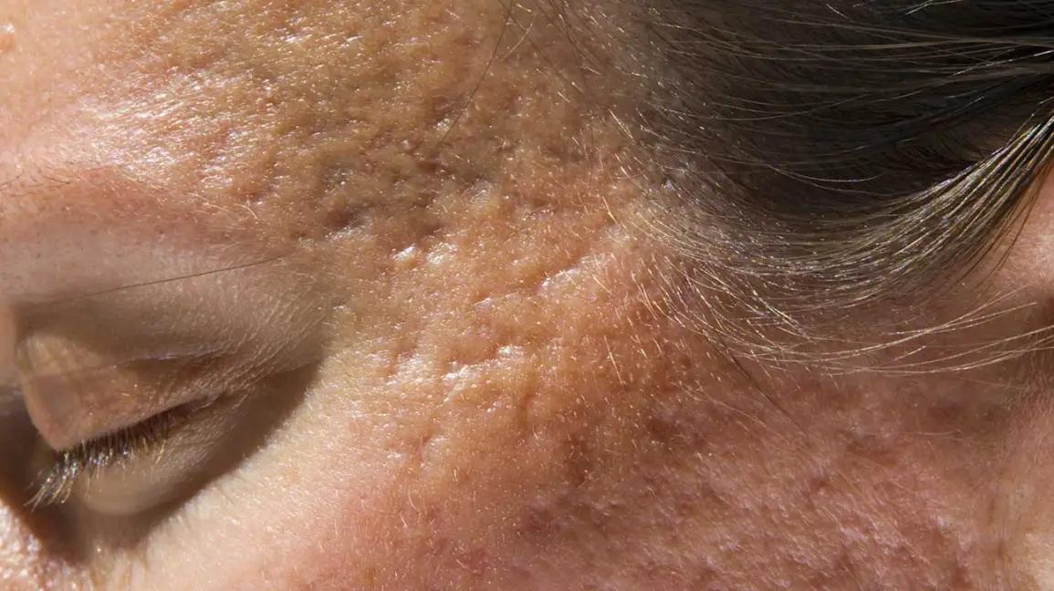 Sẹo mụn hình thành do chữa trị sai cách