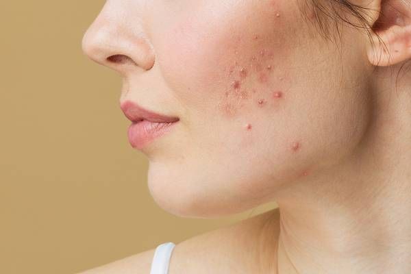 Mụn trứng cá mức độ trung bình
