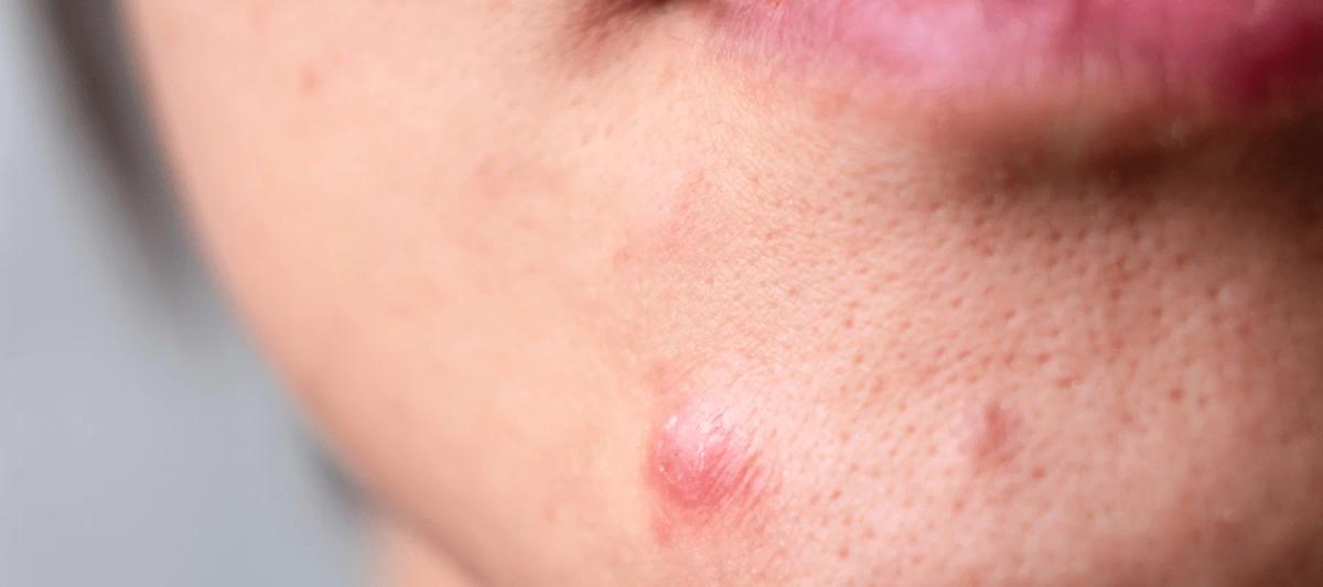 Mụn dưới da xuất hiện ở vùng cằm