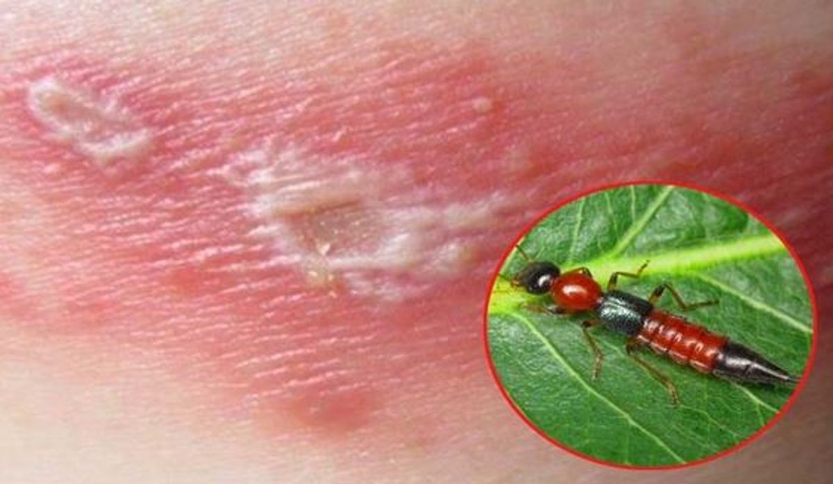 Viêm da tiếp xúc do kiến ba khoang
