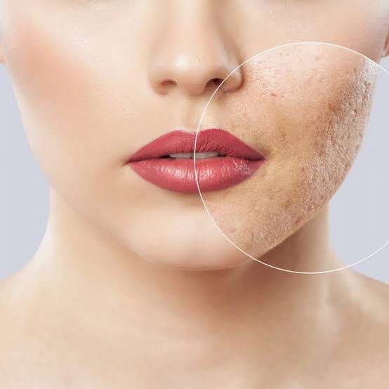 Sẹo mụn ở nữ giới