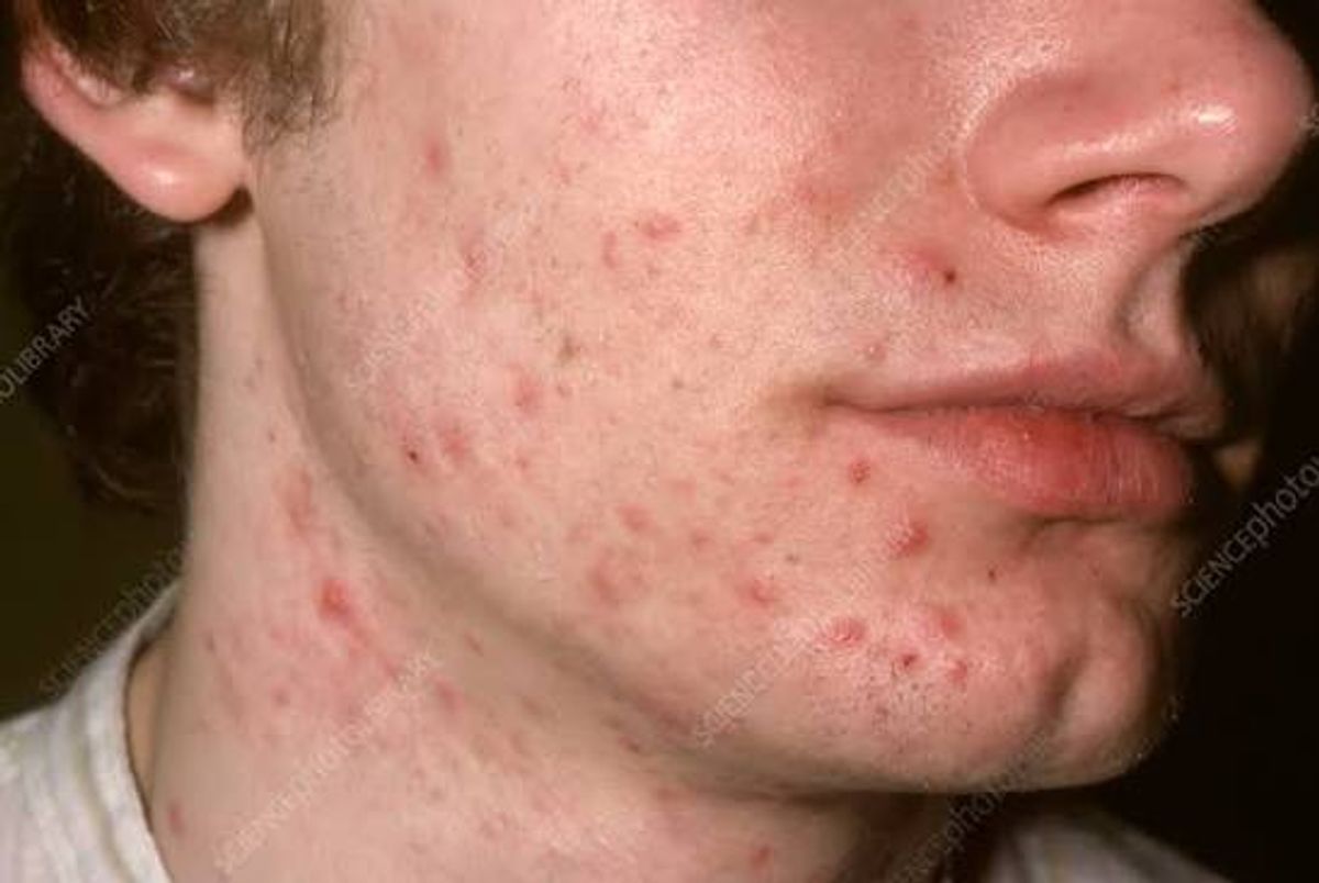 Mụn nội tiết ở nam giới xuất quanh phần cằm 