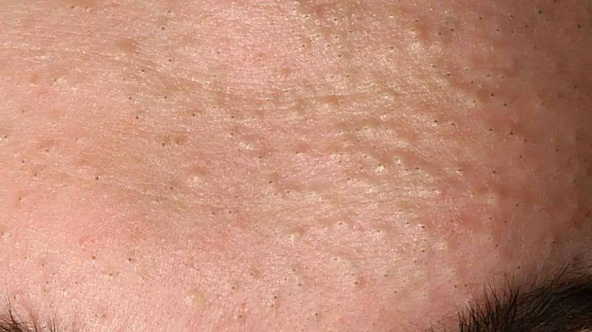 Mụn ẩn ở vùng trán 