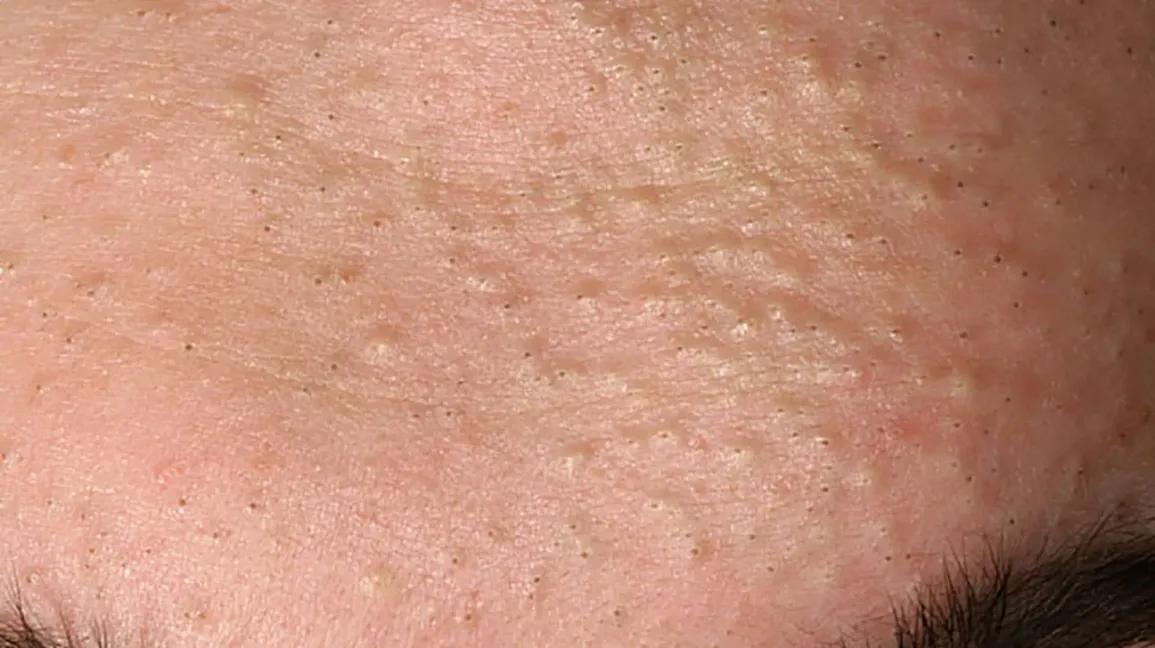 Mụn ẩn ở vùng trán
