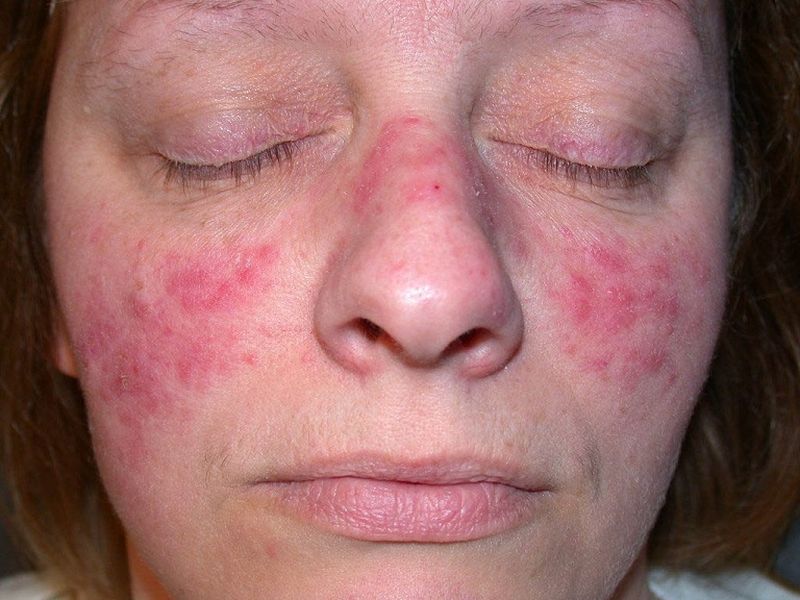Ban cánh bướm ở mặt đặc trưng của bệnh Lupus ban đỏ