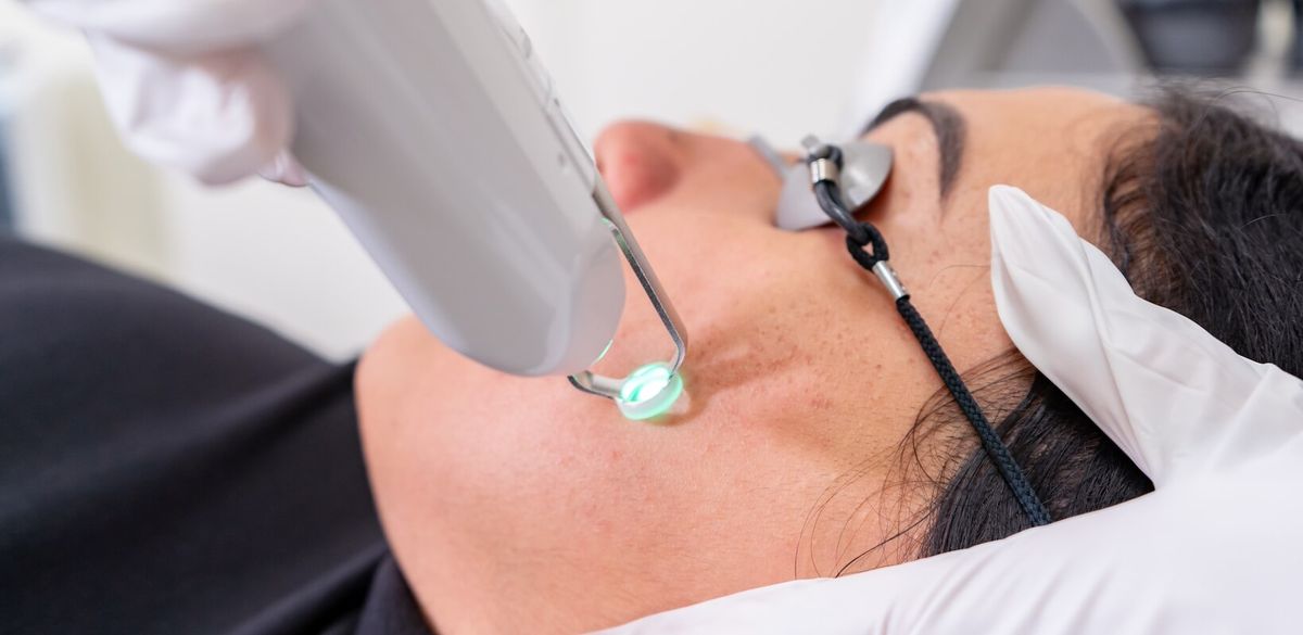 Laser trị mụn đúng vùng 