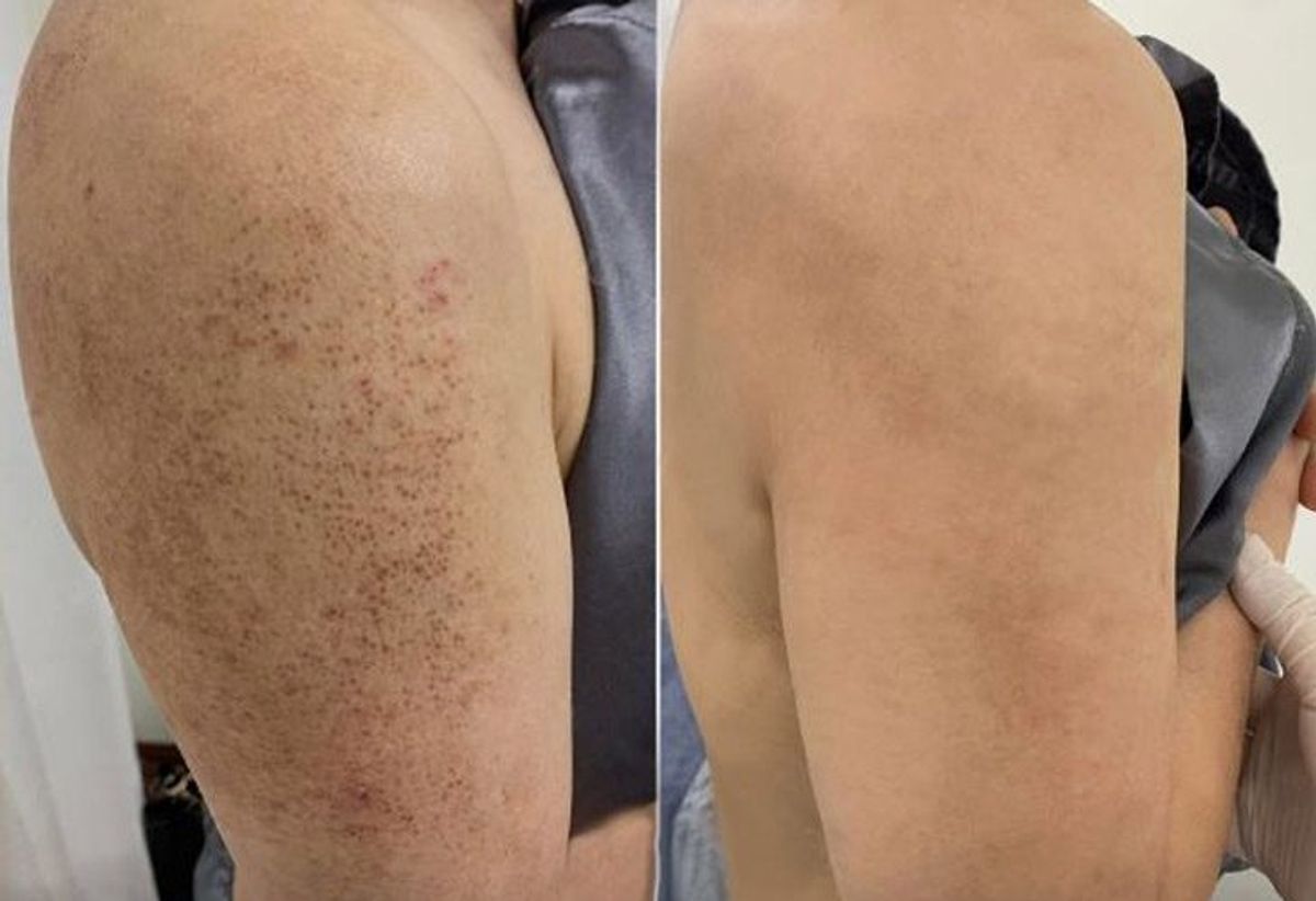 Tình trạng viêm nang lông cải thiện sau 2 tháng điều trị 