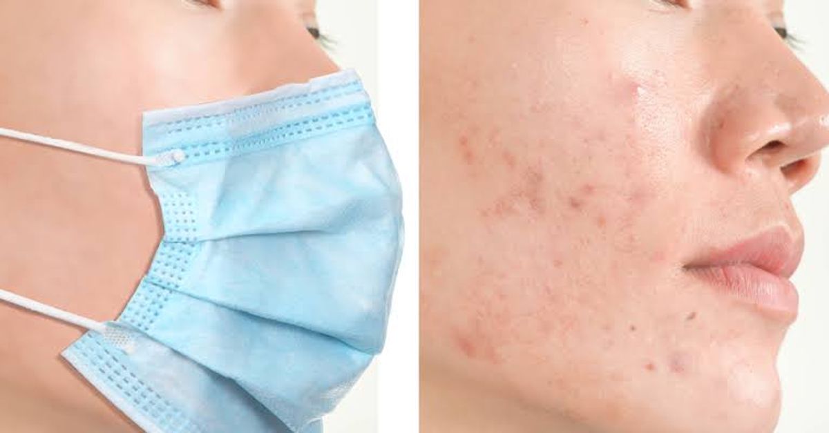 Mụn do đeo khẩu trang nhiều vì bị bít tắc lỗ chân lông 