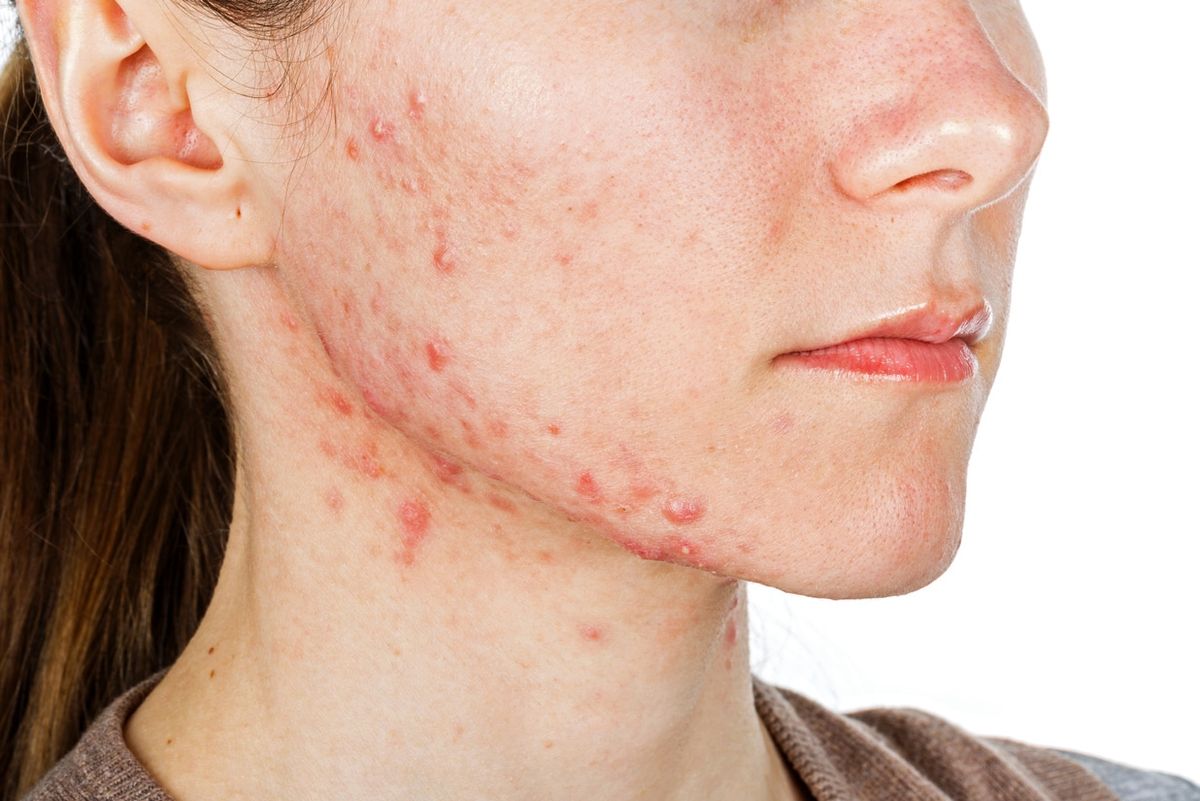 Mụn do rối loạn nội tiết dai dẳng 