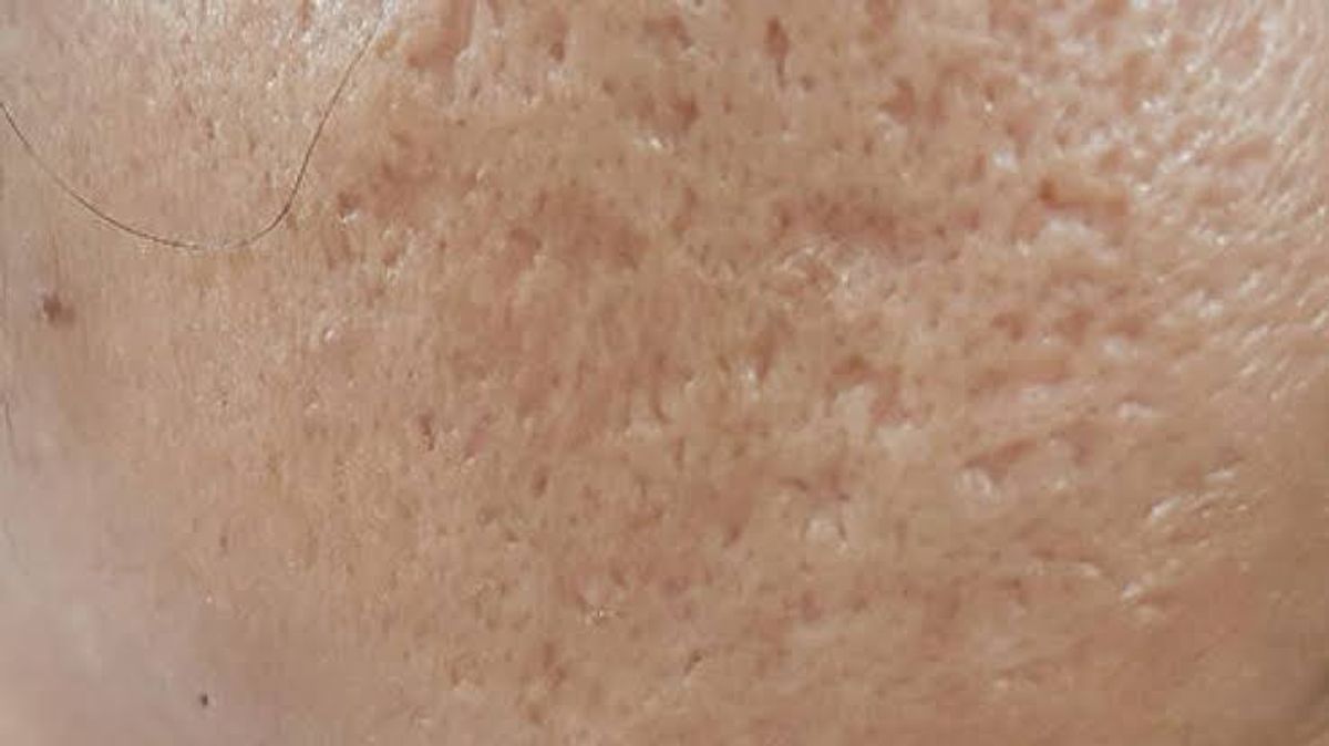 Sẹo lõm sau khi điều trị mụn 