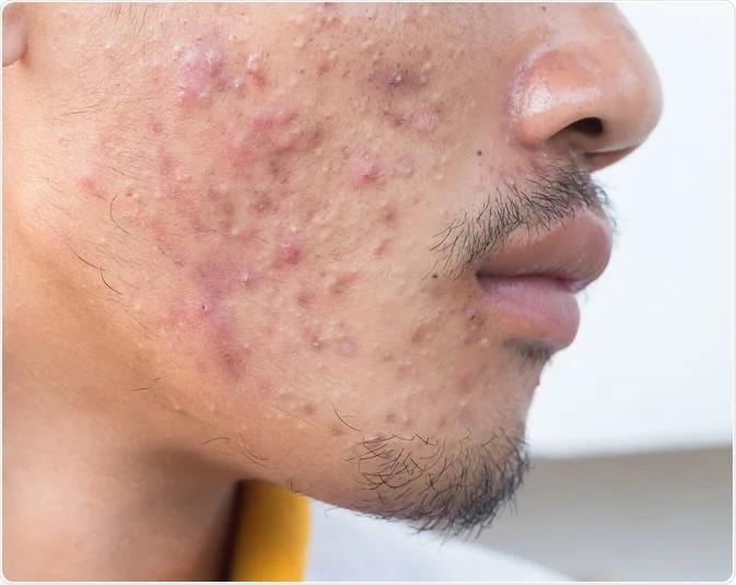 Tình trạng mụn trứng cá ở nam giới 