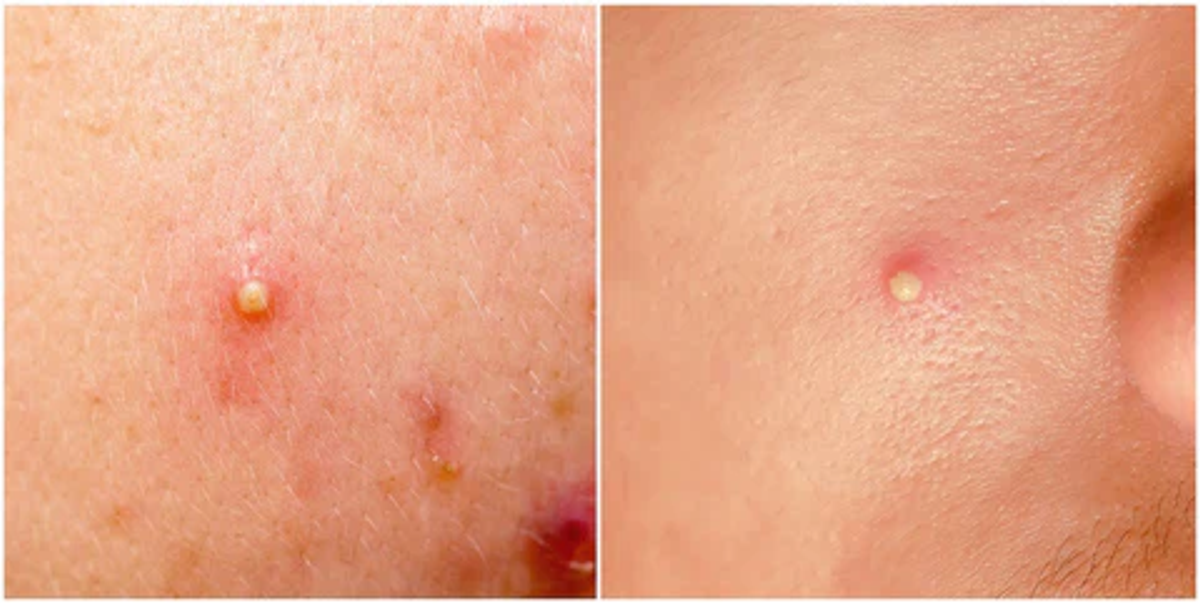 Mụn đầu trắng ở vùng má