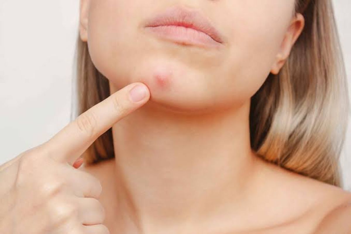 Mụn dưới da xuất hiện ở vùng cằm 