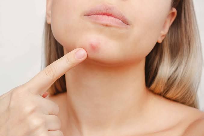 Mụn dưới da xuất hiện ở vùng cằm