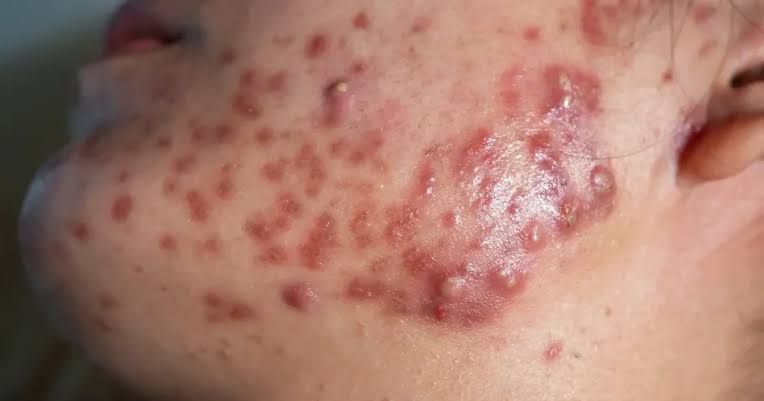 Điều trị mụn viêm vùng má