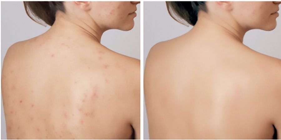 Hiệu quả sau khi peel tảo