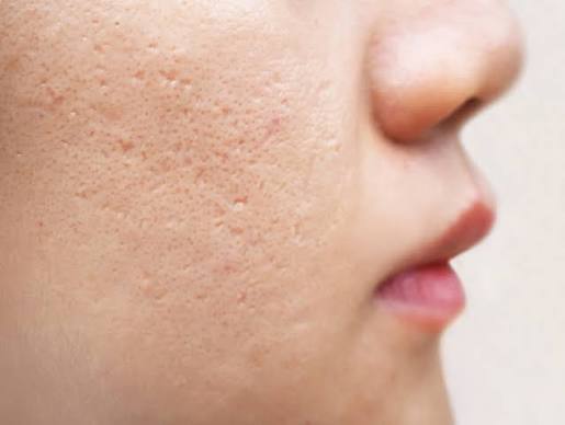 Sẹo lỗ trên vùng da mặt