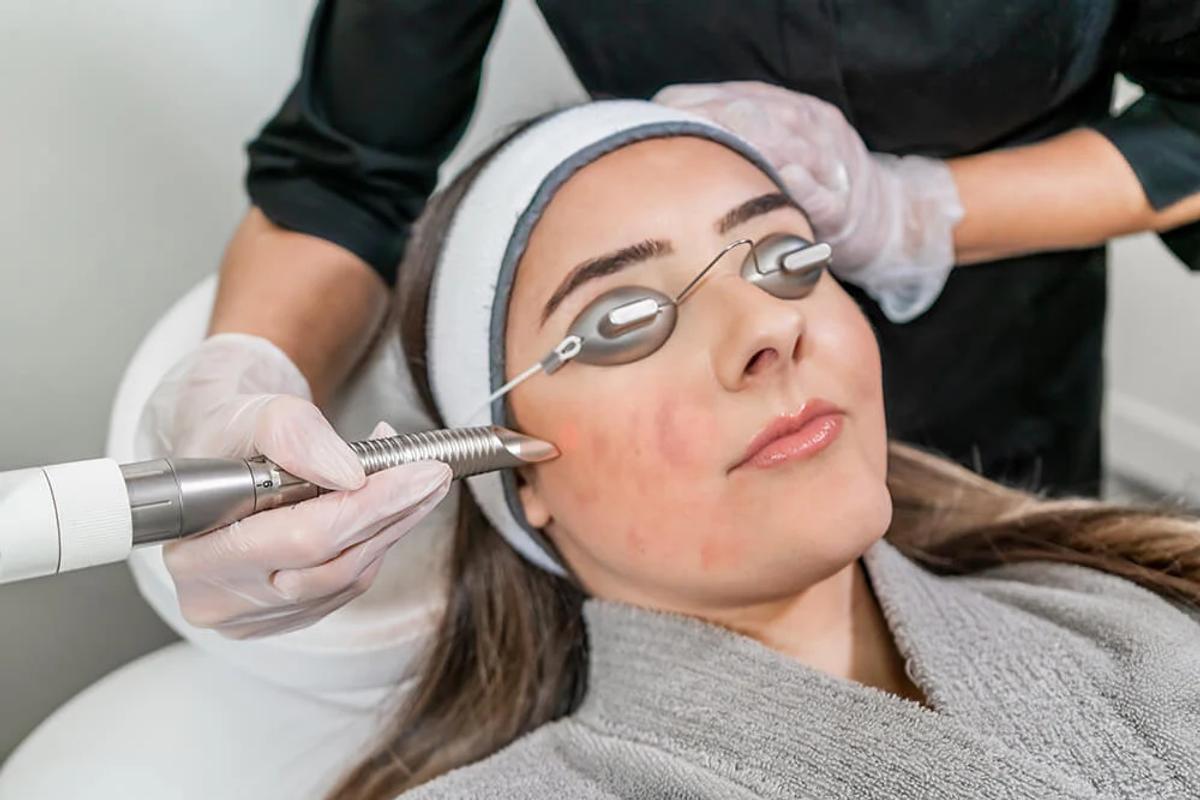 Laser trị mụn ở vùng da mụn viêm 