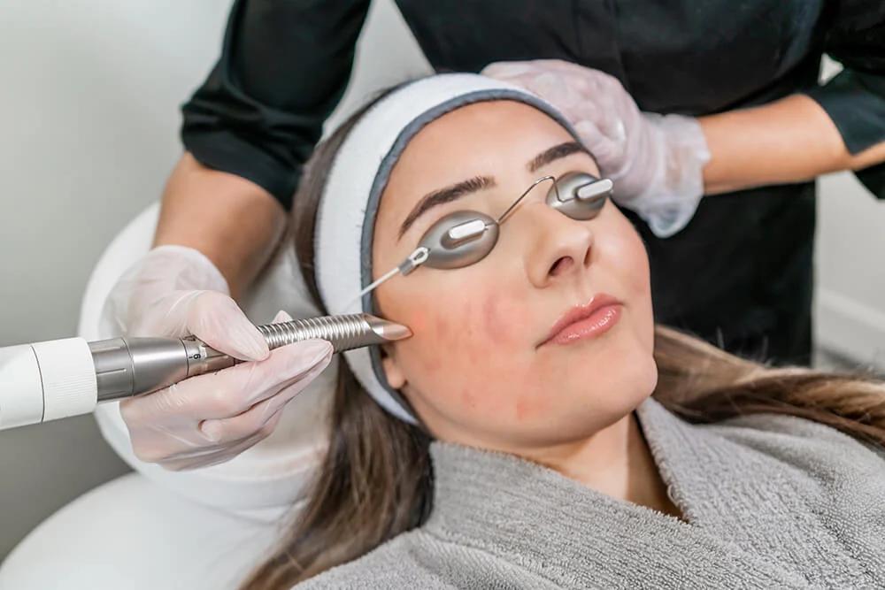 Laser trị mụn ở vùng da mụn viêm