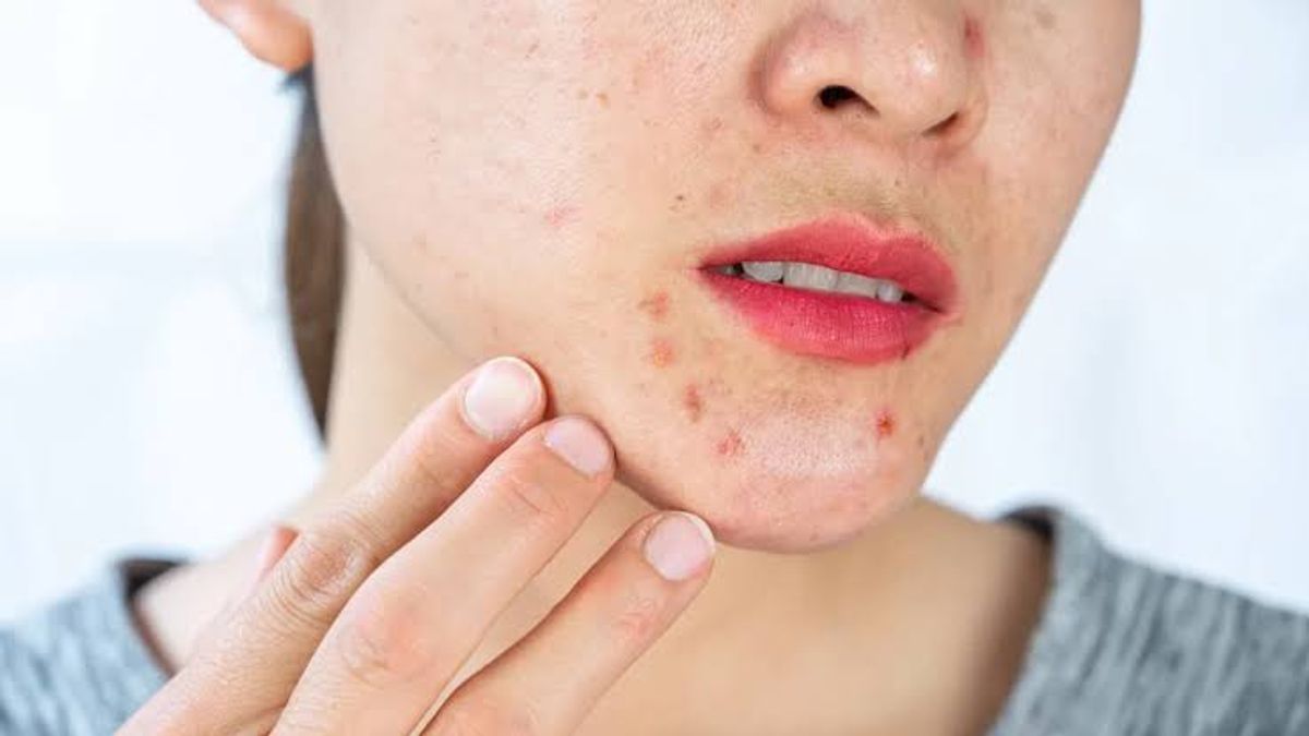 Mụn mọc rải rác xung quanh cằm 