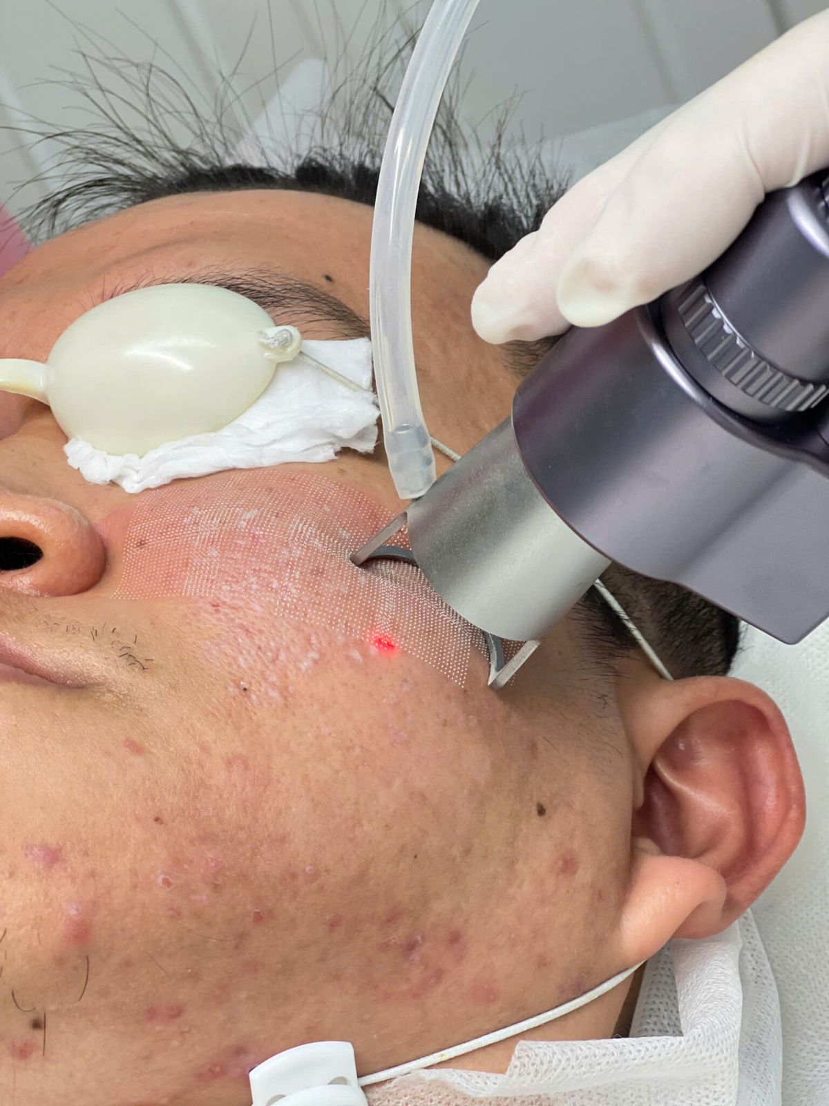 Điều trị sẹo rỗ bằng laser CO2 fractional 