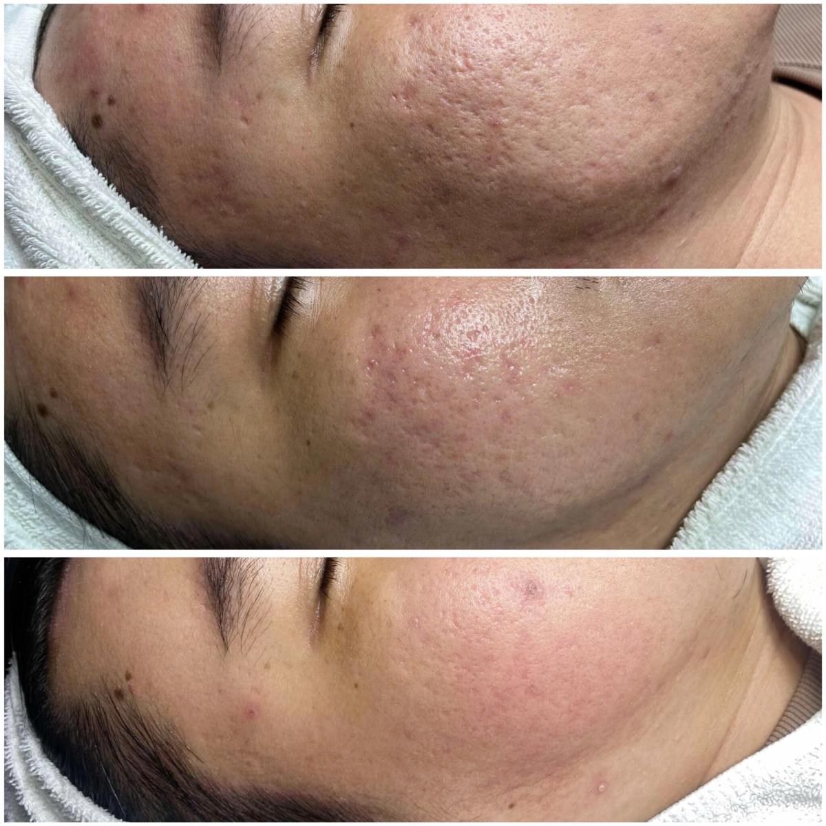 Sẹo rỗ lâu năm cải thiện sau mỗi lần điều trị