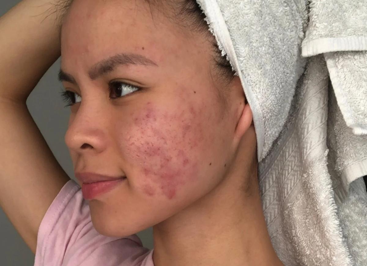 Tình trạng mụn viêm nặng lan rộng 